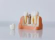 periodontal therapy at PS Dental Tigard