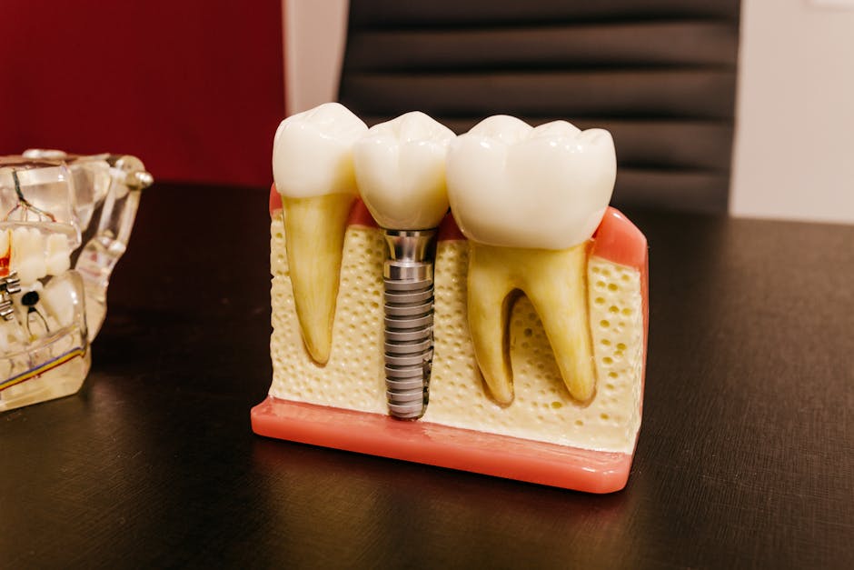 dental implant bridge